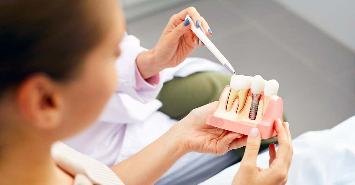 How long do dental implants actually last